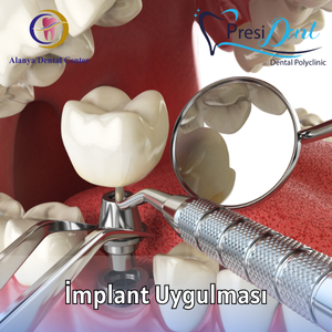 all on 6 implant