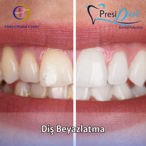 antalya diş temizleme