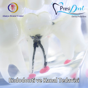 antalya kanal tedavisi ücretleri